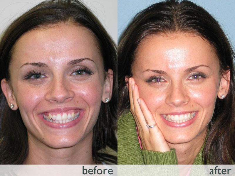 Misaligned bites causes and prevention The Blogging Doctors