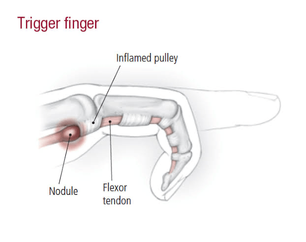 MRI of the Fingers: An Update : American Journal of.