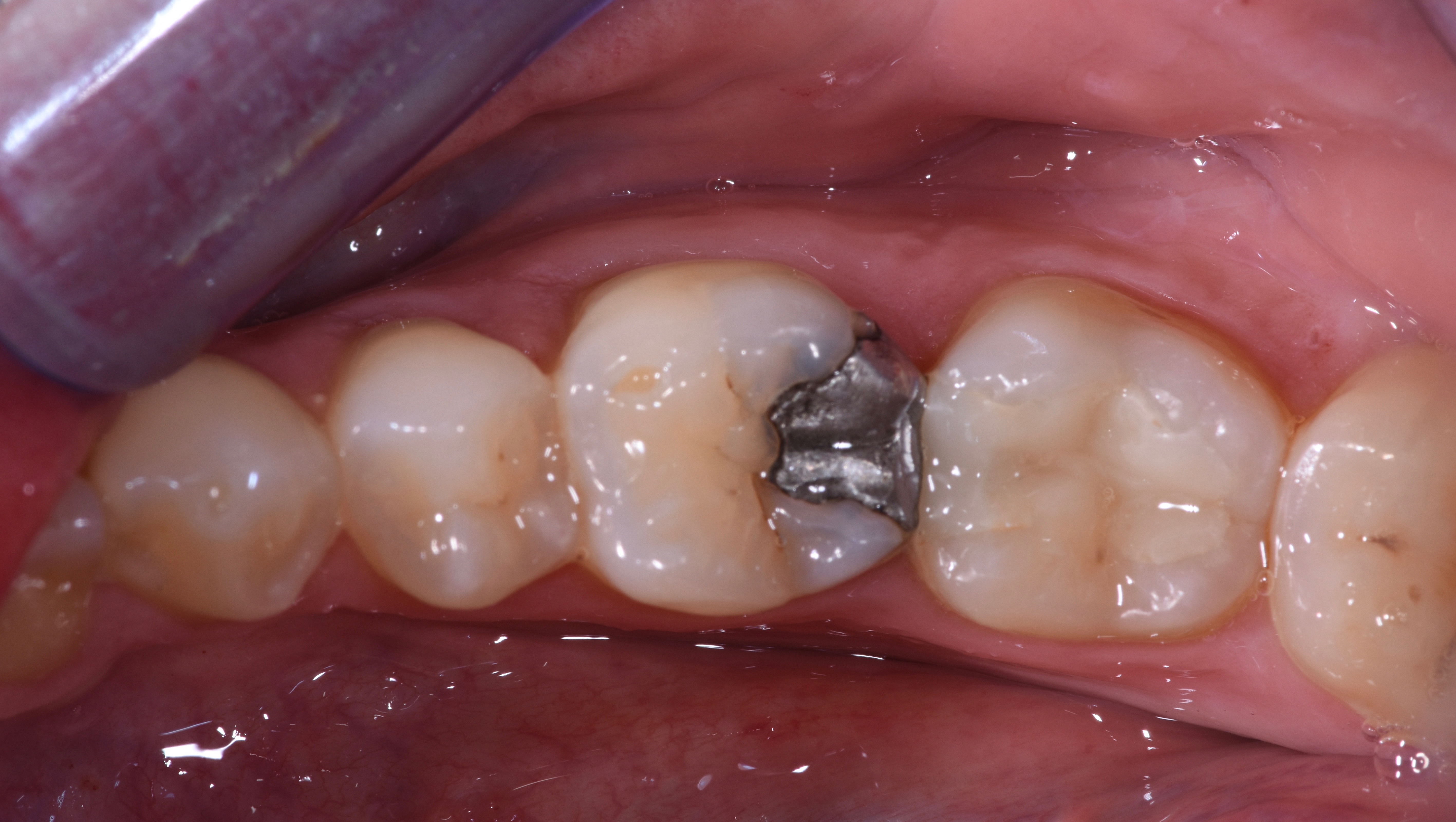 White Filling Bristol Veneers Bristol Fillings Bristol