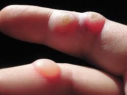 Symptoms And Affectations Bubonic Plague