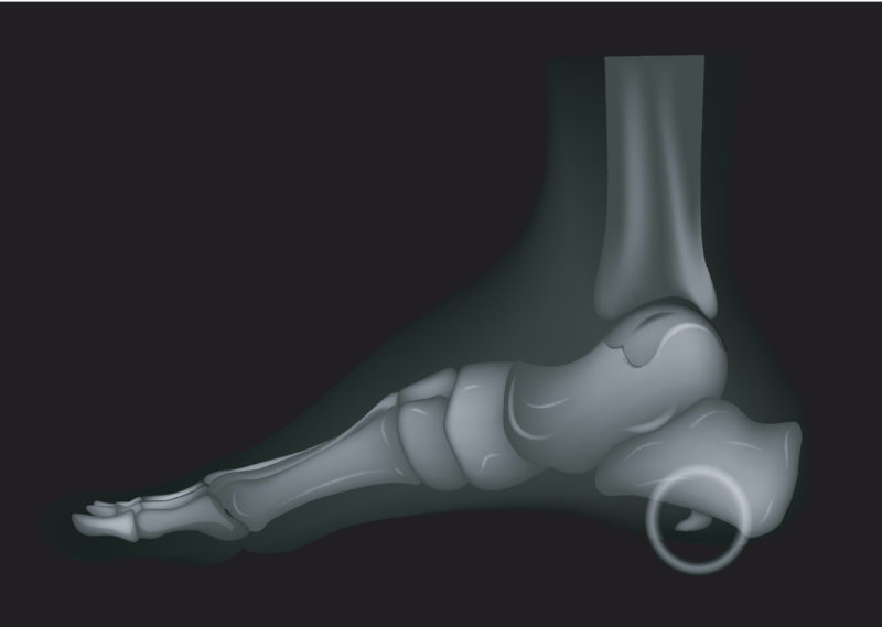 Bunion vs. Bone Spur What are the Differences? The Bunion Cure