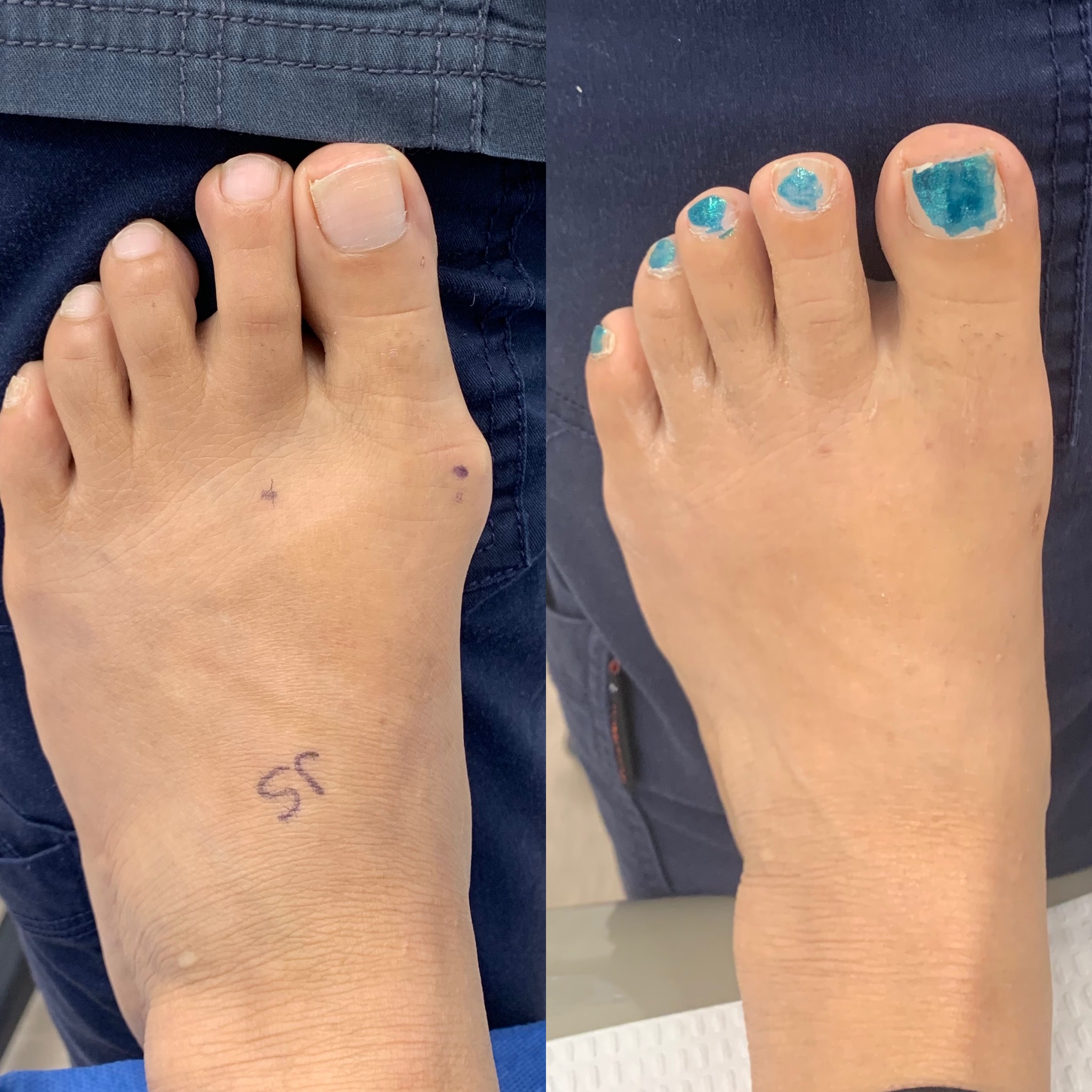 How Long Does It Take For Bunion Splint To Correct at Freddie Rabago blog
