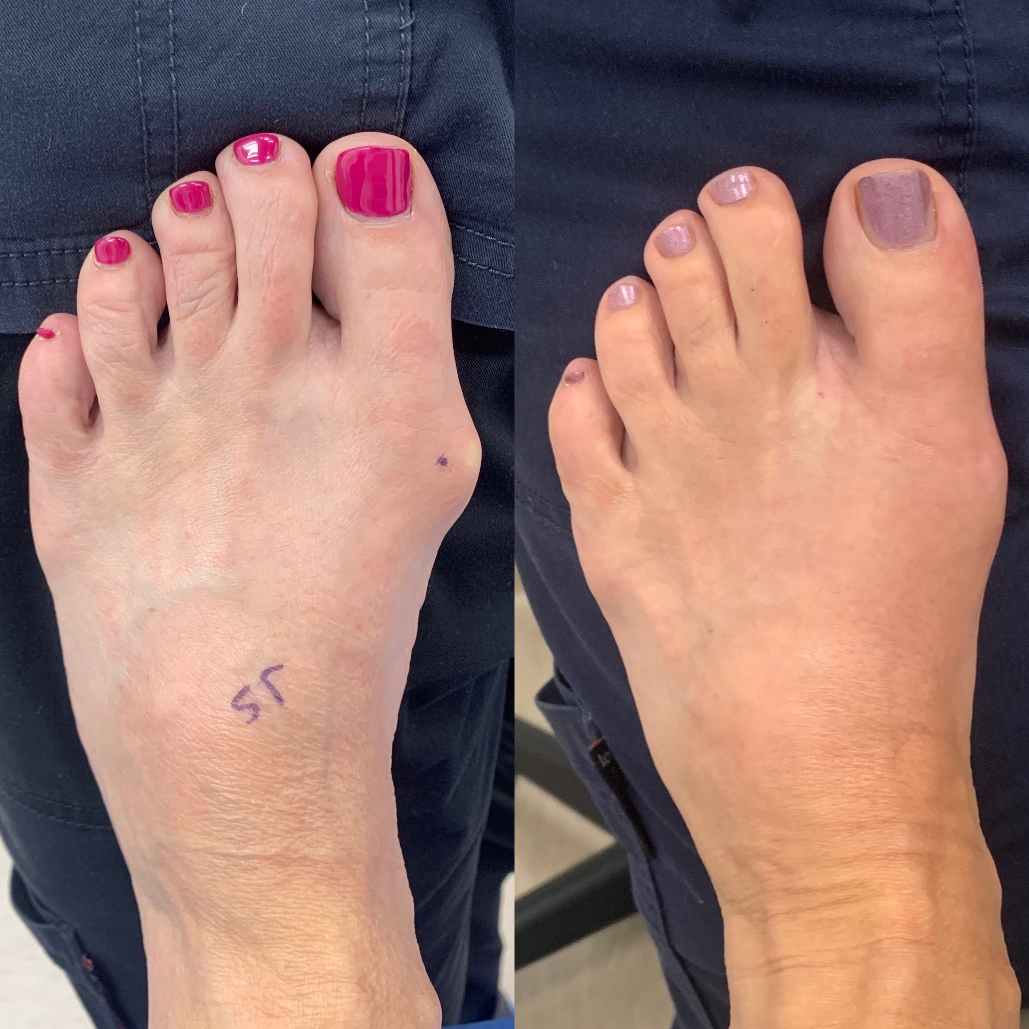 Before and After Bunion Surgery Photos The Bunion Cure