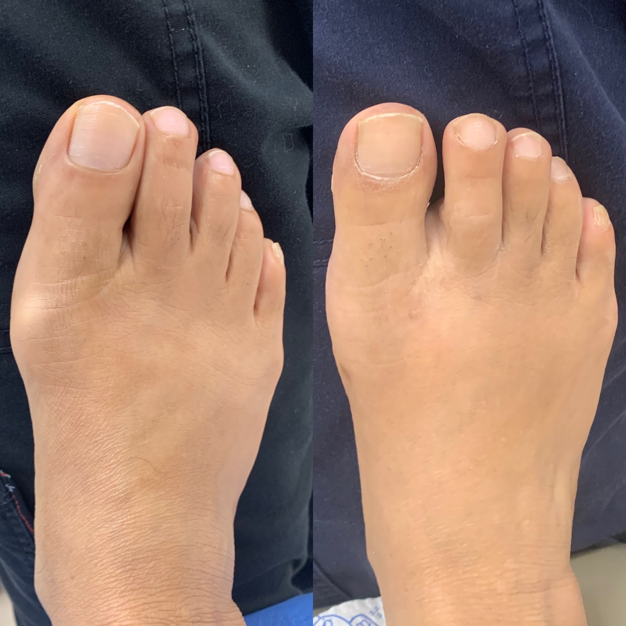 Before and After Bunion Surgery Photos The Bunion Cure