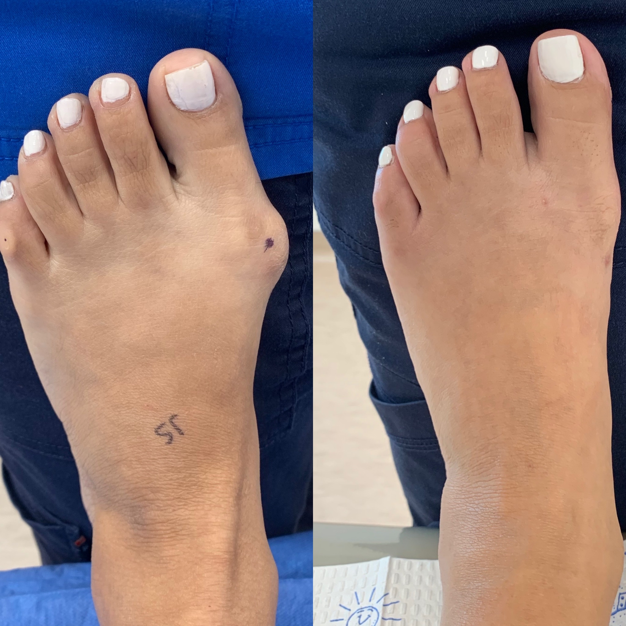 Before and After Bunion Surgery Photos Northwest Surgery Center