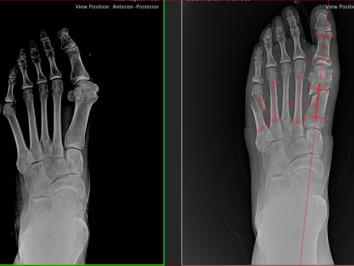 Bunionectomy X Ray