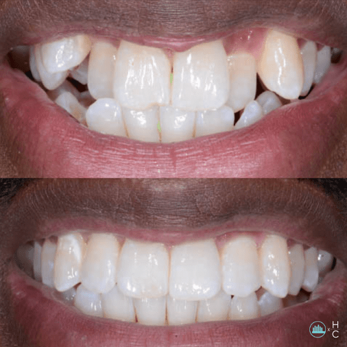 Invisalign Best Invisible Braces The Chicago Dental Studio