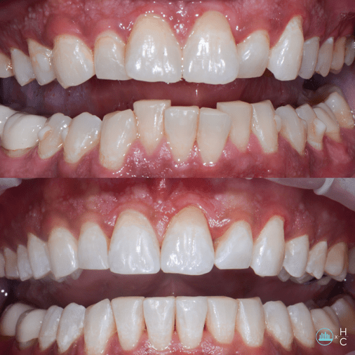 Invisalign Best Invisible Braces The Chicago Dental Studio