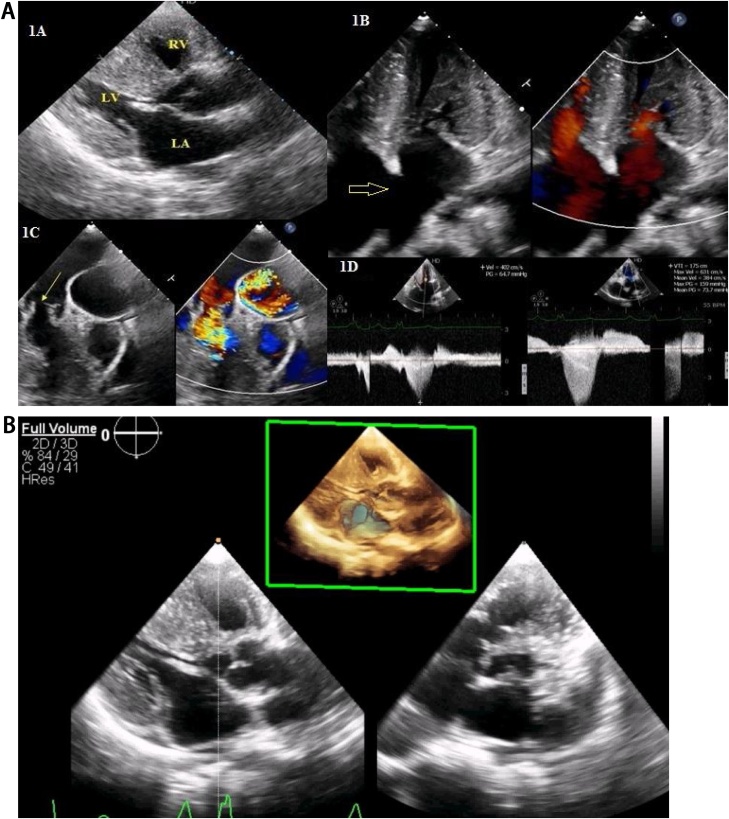 Combined cardiac anomalies in Noonan syndrome A case report