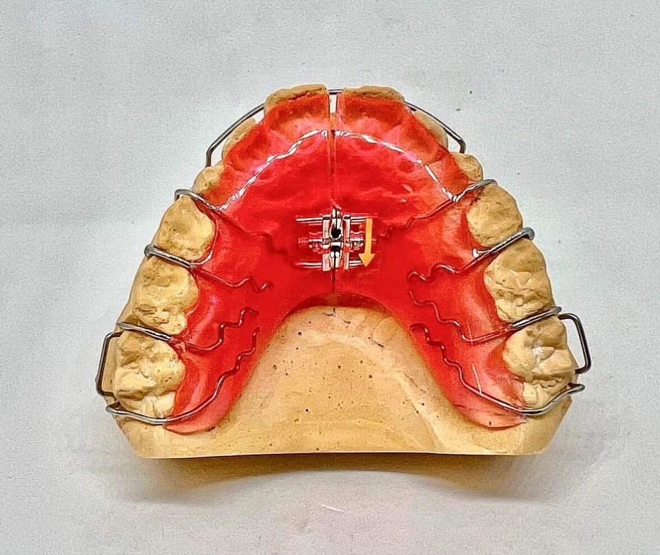 Hawley Orthodontic Retainer, Buy One Get One 30 Off BOGO! Use code H