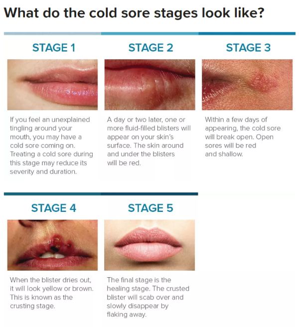 Fever Blister on Lip & Cold Sores Symptoms, Treatment & More