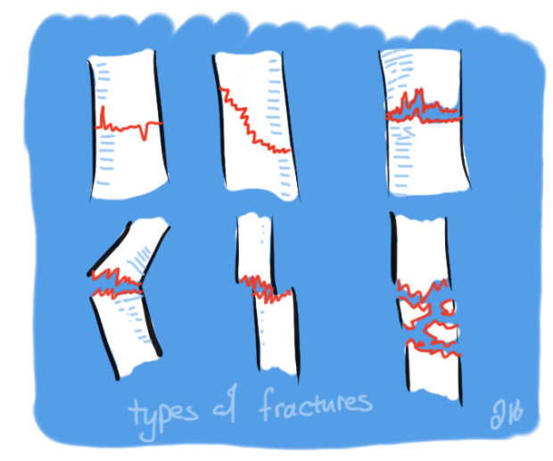 MSK 11 6 Steps you MUST know in fracture healing Common Rounds
