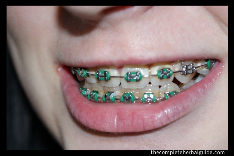 5 Options to Afford Adult Braces The Complete Herbal Guide