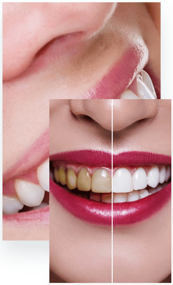 Dental Veneers The Cross Dental Practice