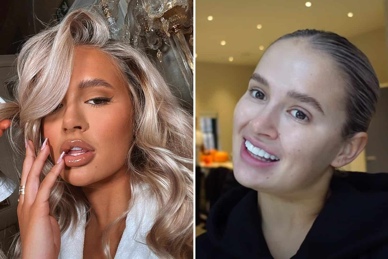 Dissolving Lip Filler Everything you Need to Know the daily glimmer