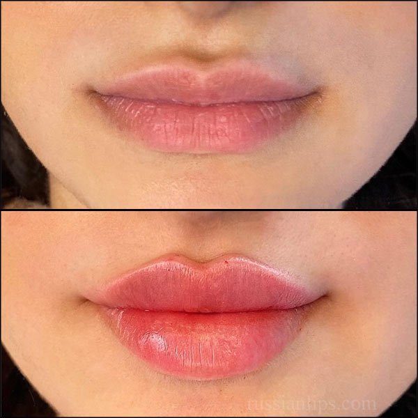 Russian Lip Filler Technique vs Normal What's The Difference? the