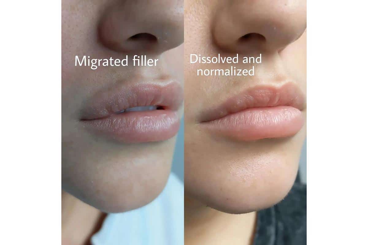How to Fix Migrated Lip Filler the daily glimmer