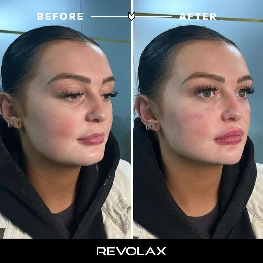 Lip Filler Before and After Photos and Results the daily glimmer