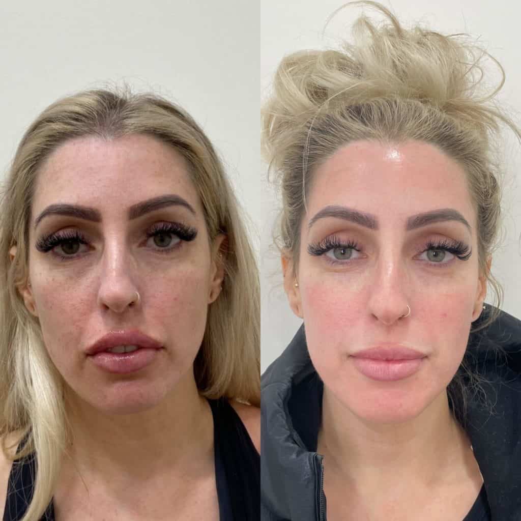 9 Amazing PRP Facial Benefits the daily glimmer