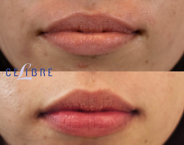 Botox Lip Flip Side Effects the daily glimmer