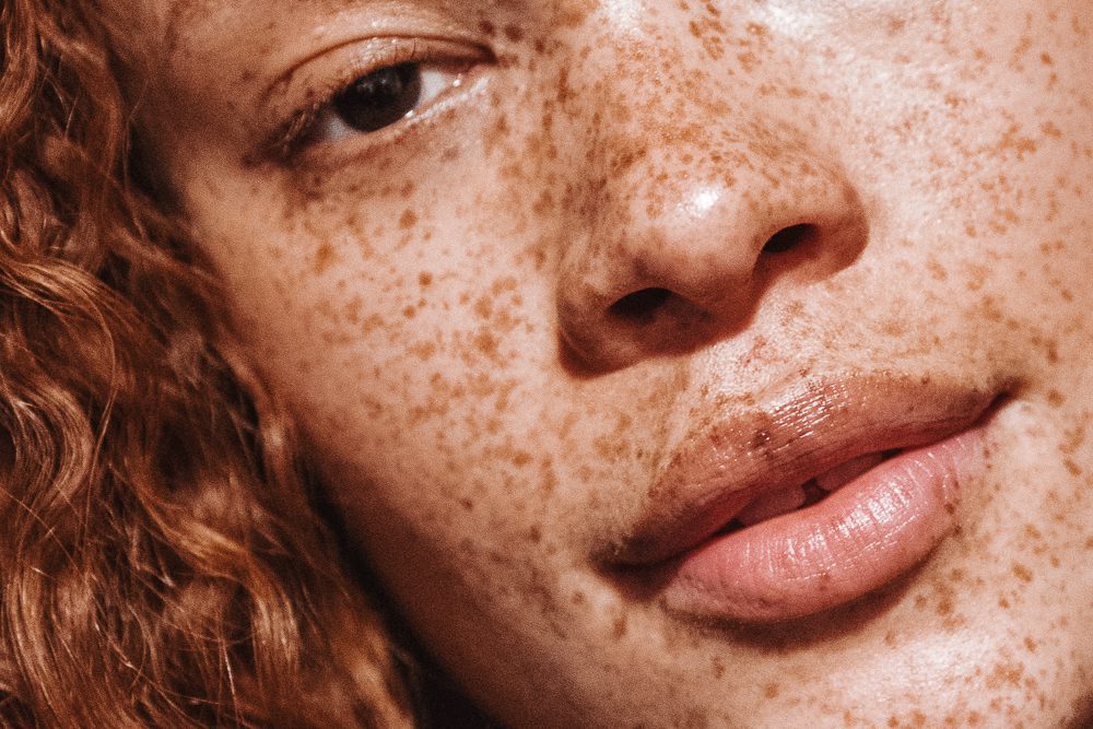 Sun spots vs Freckles What's The Difference? the daily glimmer