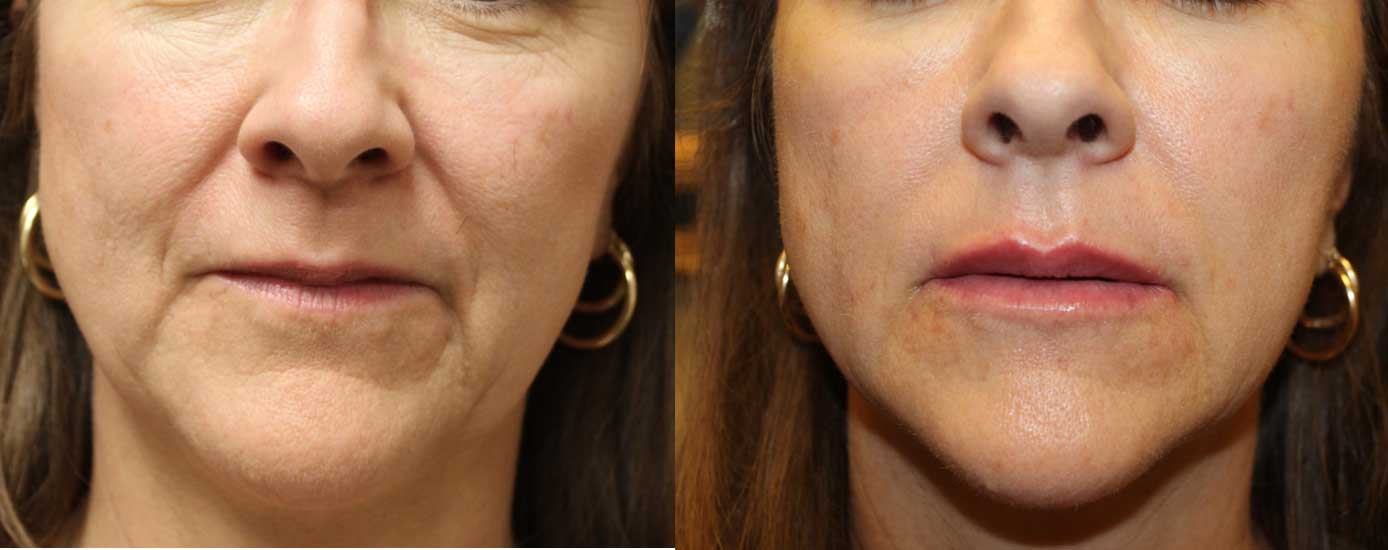 Lines Filler Everything you need to know the daily glimmer