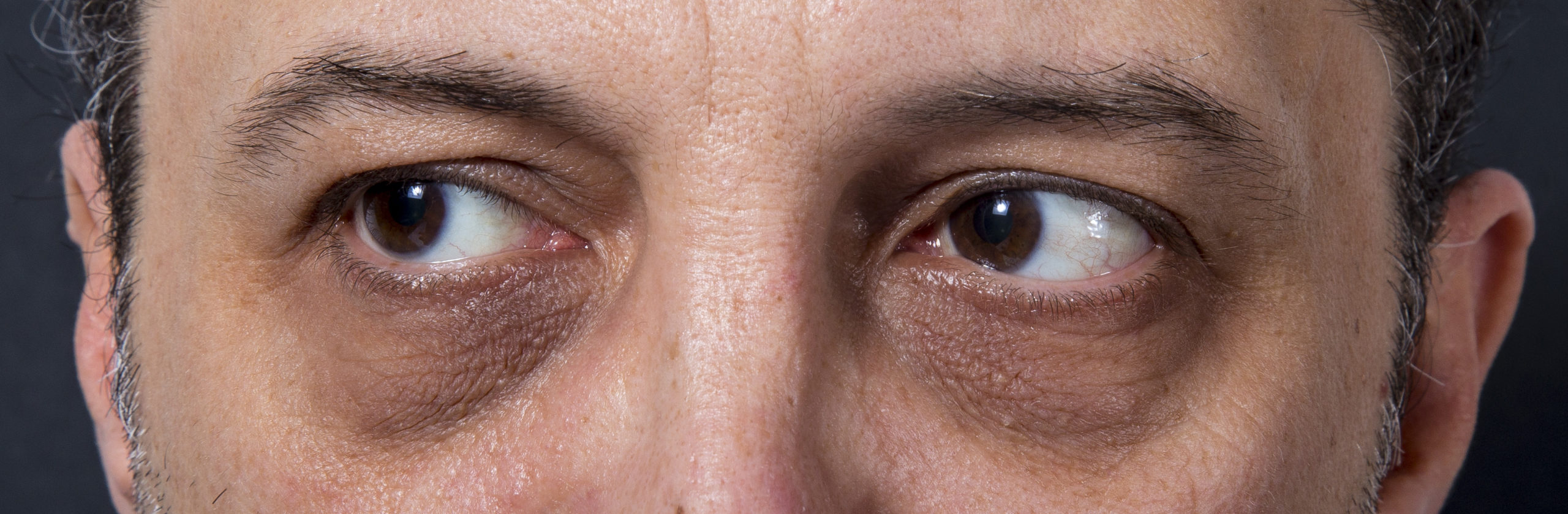 The Death of Ugly Eye Bags Why I’ll Never Look Tired Again The Daily