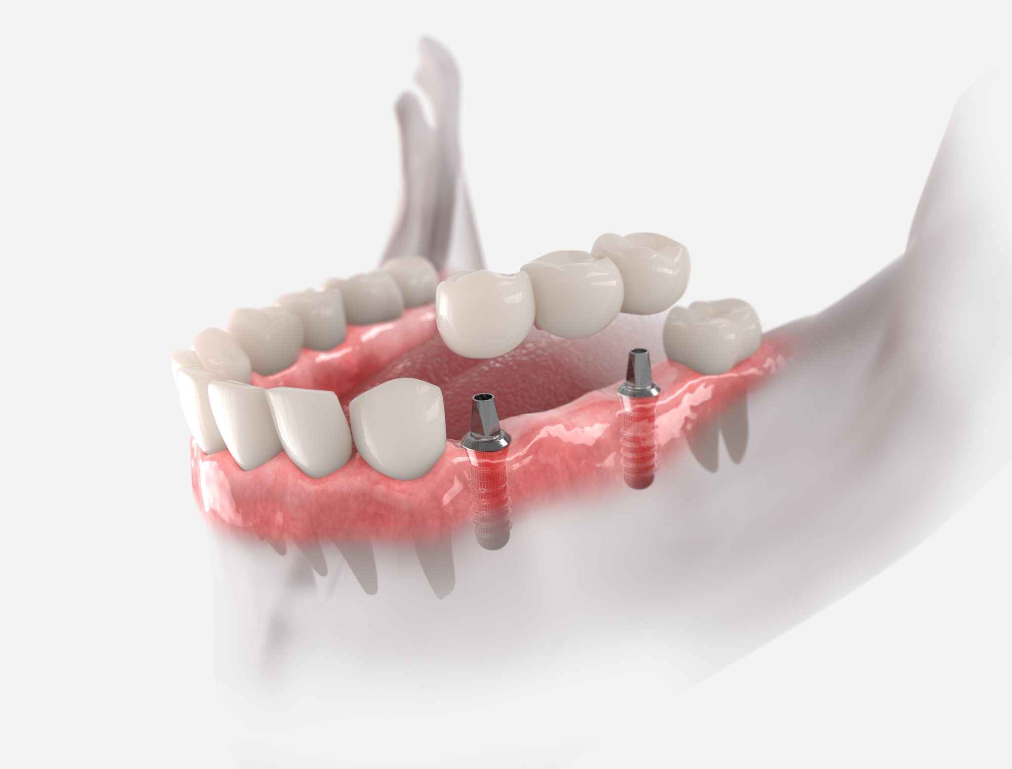 Securing Your Dental Bridge With Implants Fort Worth, TX
