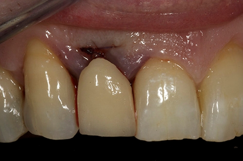 Case Study 3 Single Tooth Replacement Cirencester Dental Implant Clinic