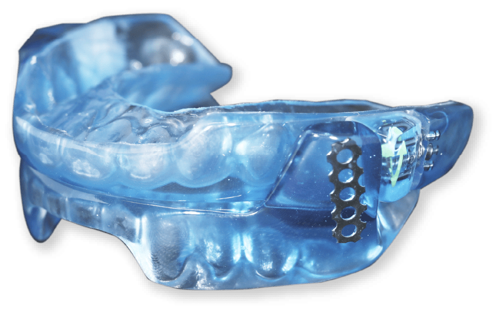 What Is A Mandibular Advancement Device? Faceology, 52 OFF
