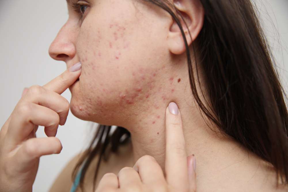 Itchy acne can be very annoying, check out how to soothe it!