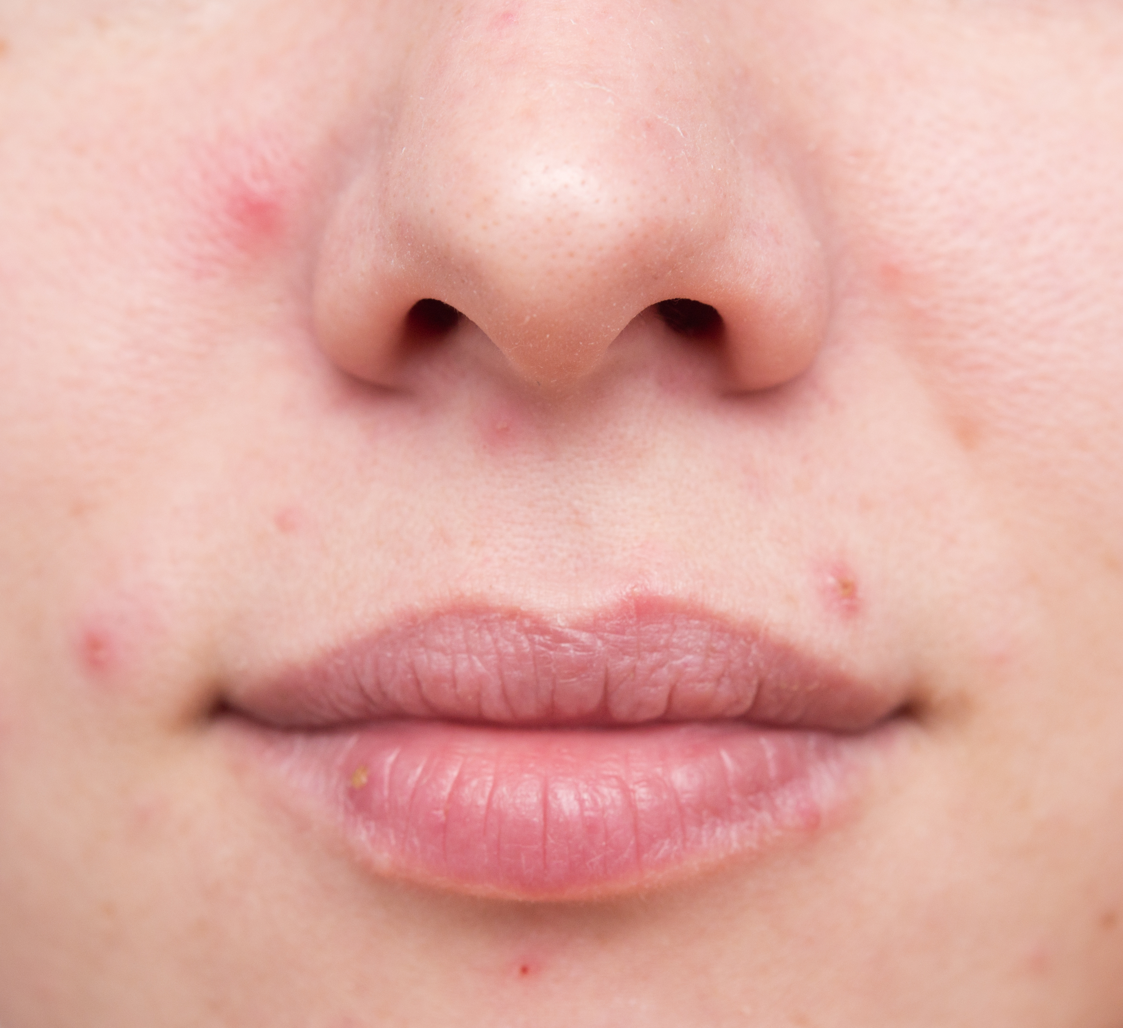 Stress Acne What It Is, Its Causes and How You Can Banish It