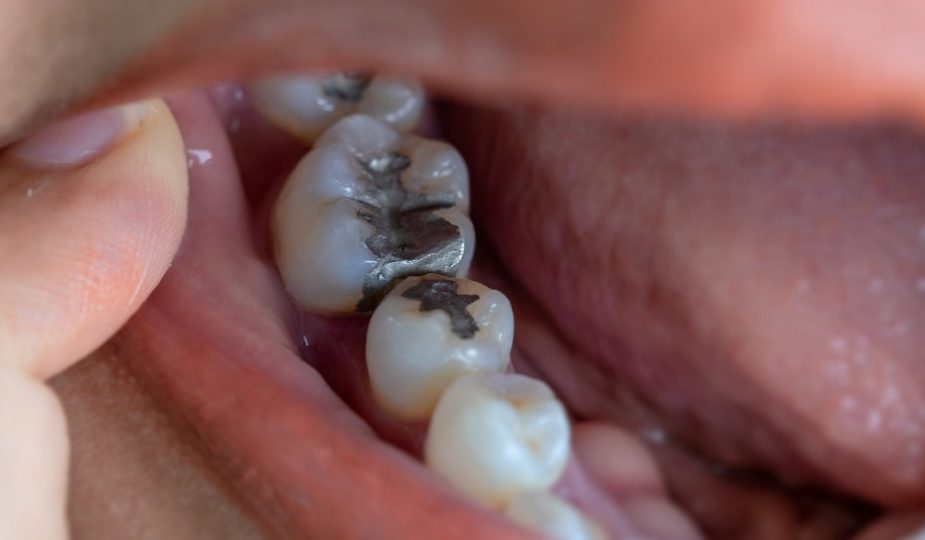 Rawatan Filling Gigi Apa Yang Anda Perlu Tahu? The Diagnosa