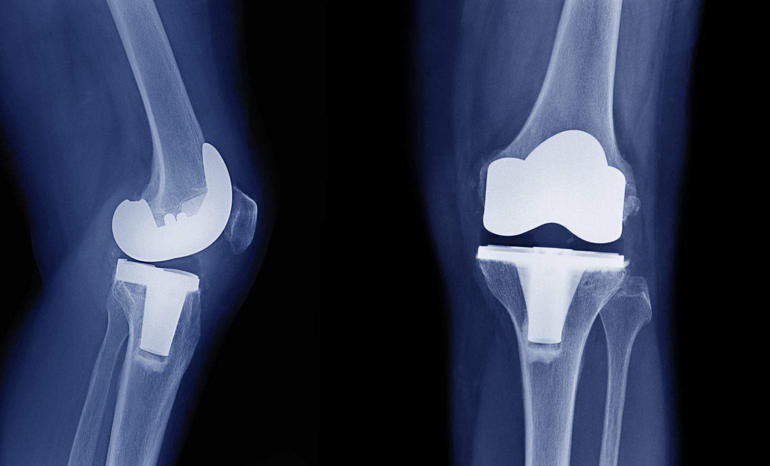 Total Knee Replacements Procedures & Alternatives to Knee Replacement