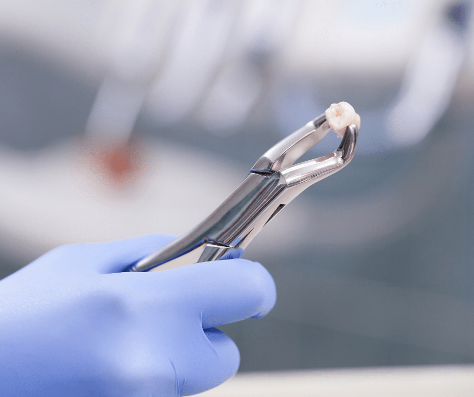 Root Canal or Tooth Extraction? Pros and Cons The Endo House