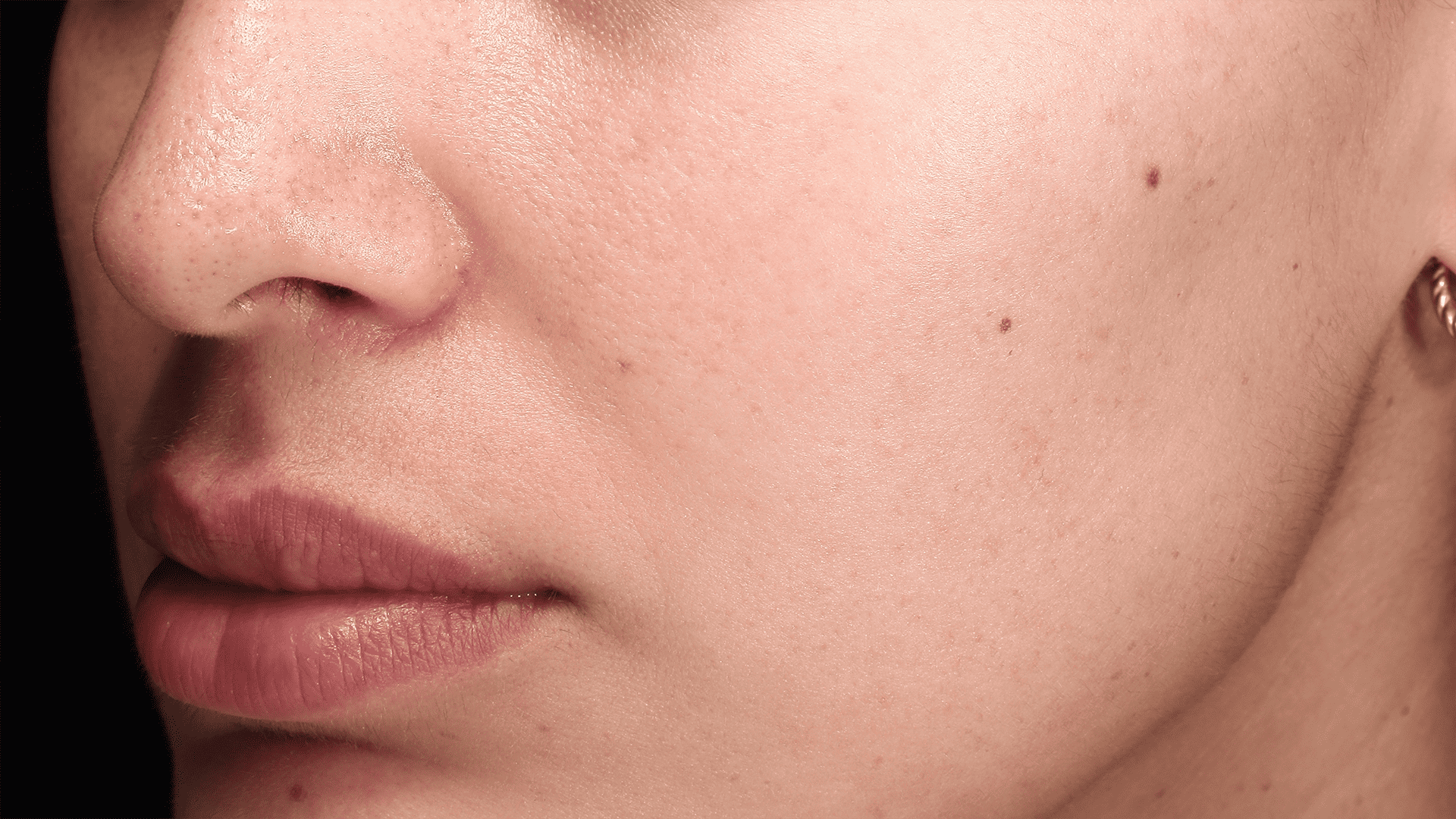 Fractional Laser Sydney Laser Clinic Darlinghurst