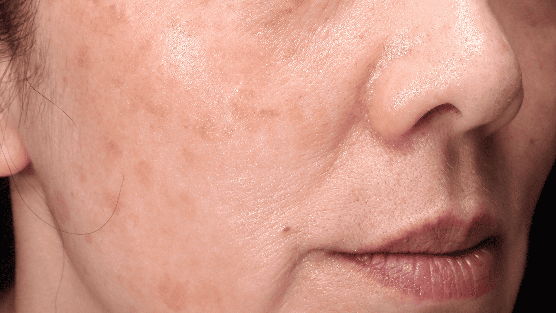 Fractional Laser Sydney Laser Clinic Darlinghurst