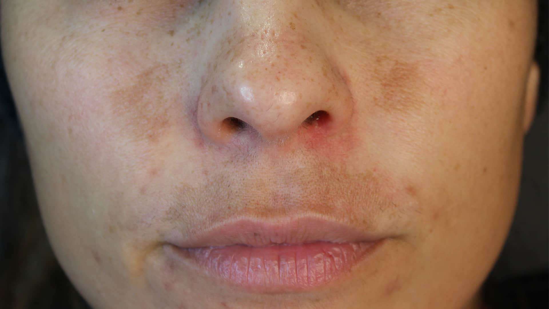 Dermamelan Peel The Face Bar Laser Clinic Darlinghurst Sydney