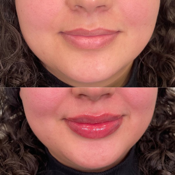Lip Filler Full Syringe The Flawless Lab Scottsdale, Arizona