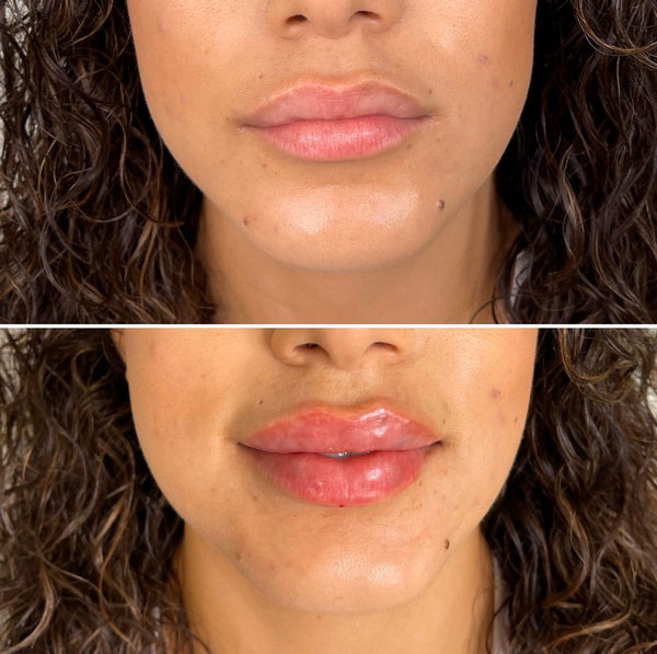 Lip Filler Full Syringe The Flawless Lab Scottsdale, Arizona