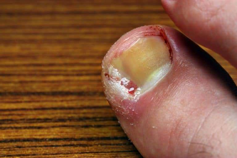 Ingrown Toenails The Foot Care Group