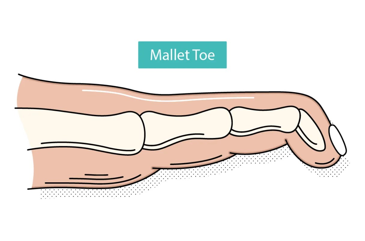 Hammer toe Causes, Diagnosis and Treatment The Foot Hub