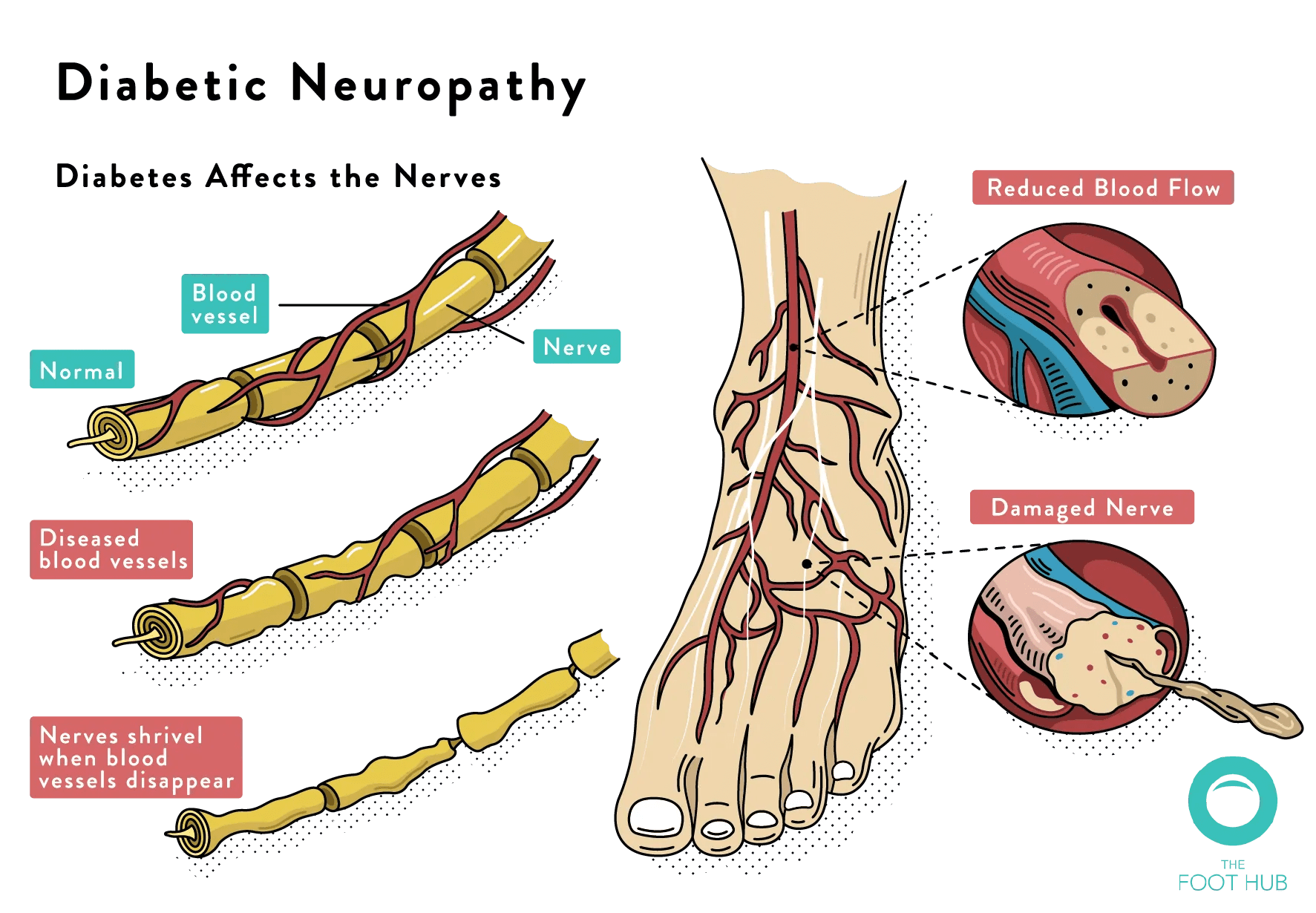 Diabetic Foot Assessment The Foot Hub Diabetic Podiatrist