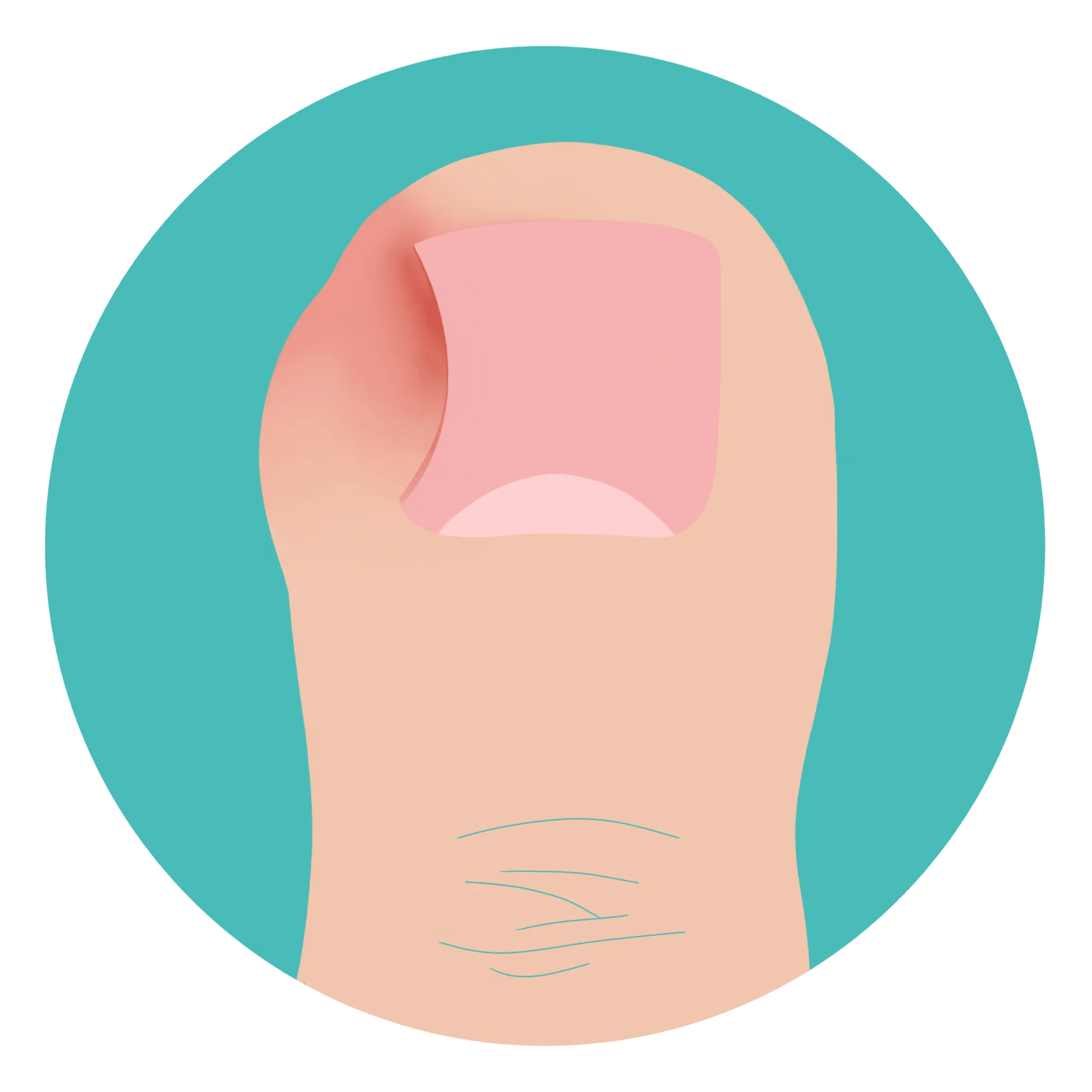 Infected Toe Causes,Symptoms & Treatment