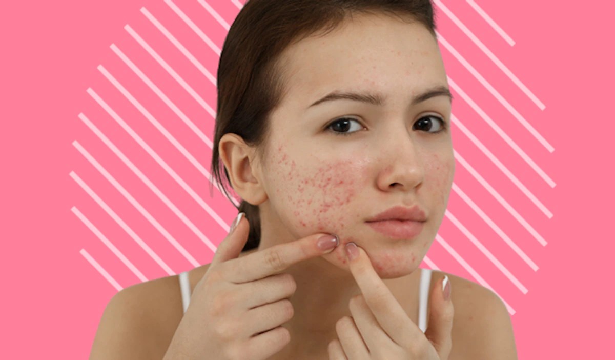 An AtHome Remedy for Acne The Frisky