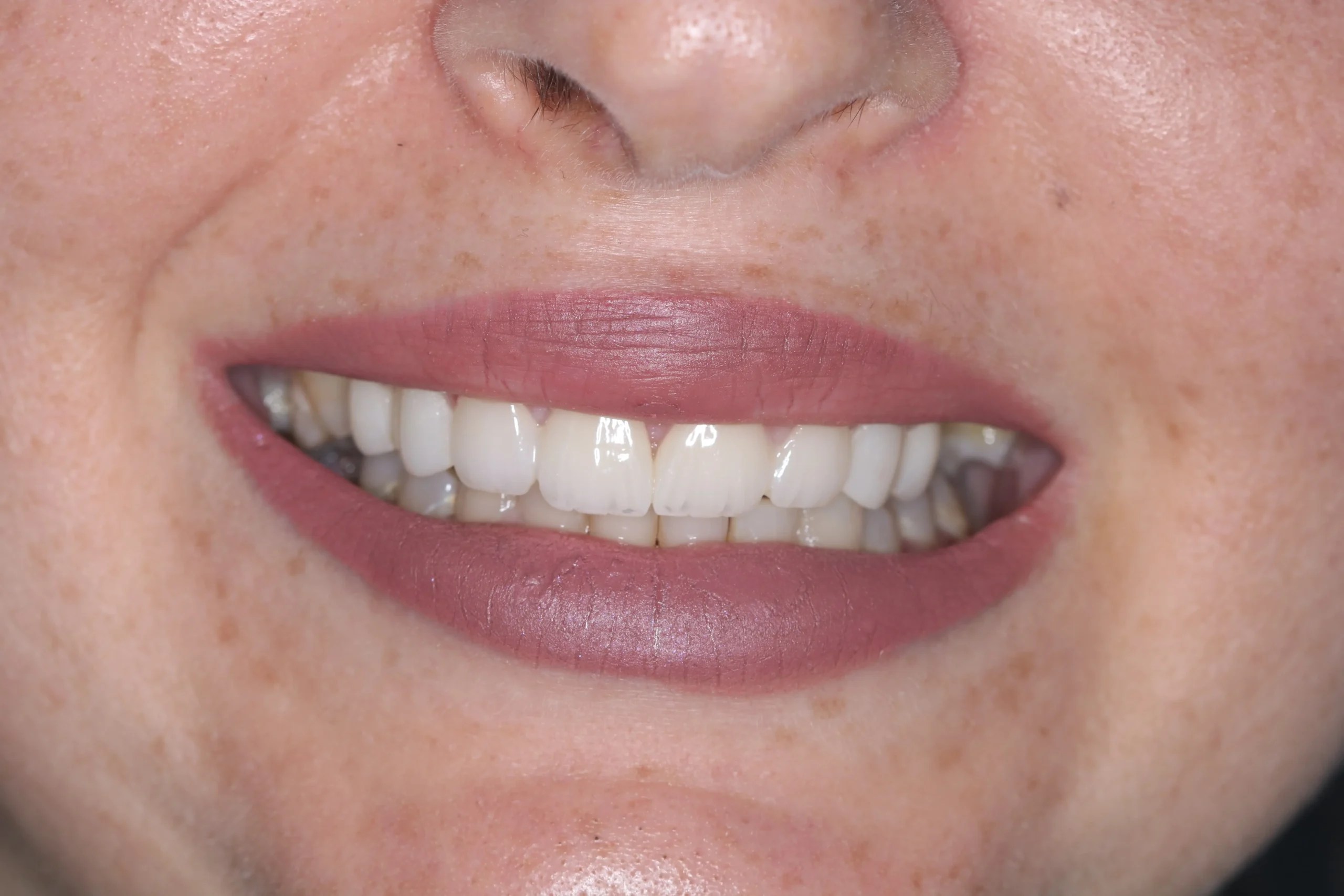 Crowns Before & After The Gentle Dentist
