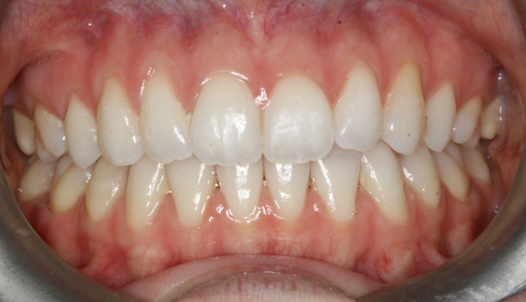Smile Gallery Six Month Smiles Glasgow Tooth Whitening Implants