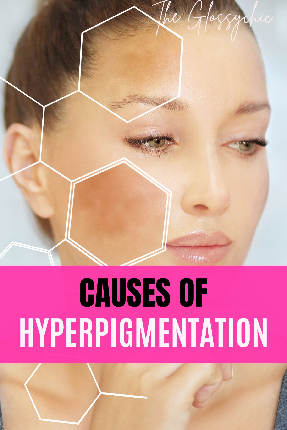 Get Rid Of Hyperpigmentation Home Remedies That Work The Glossychic