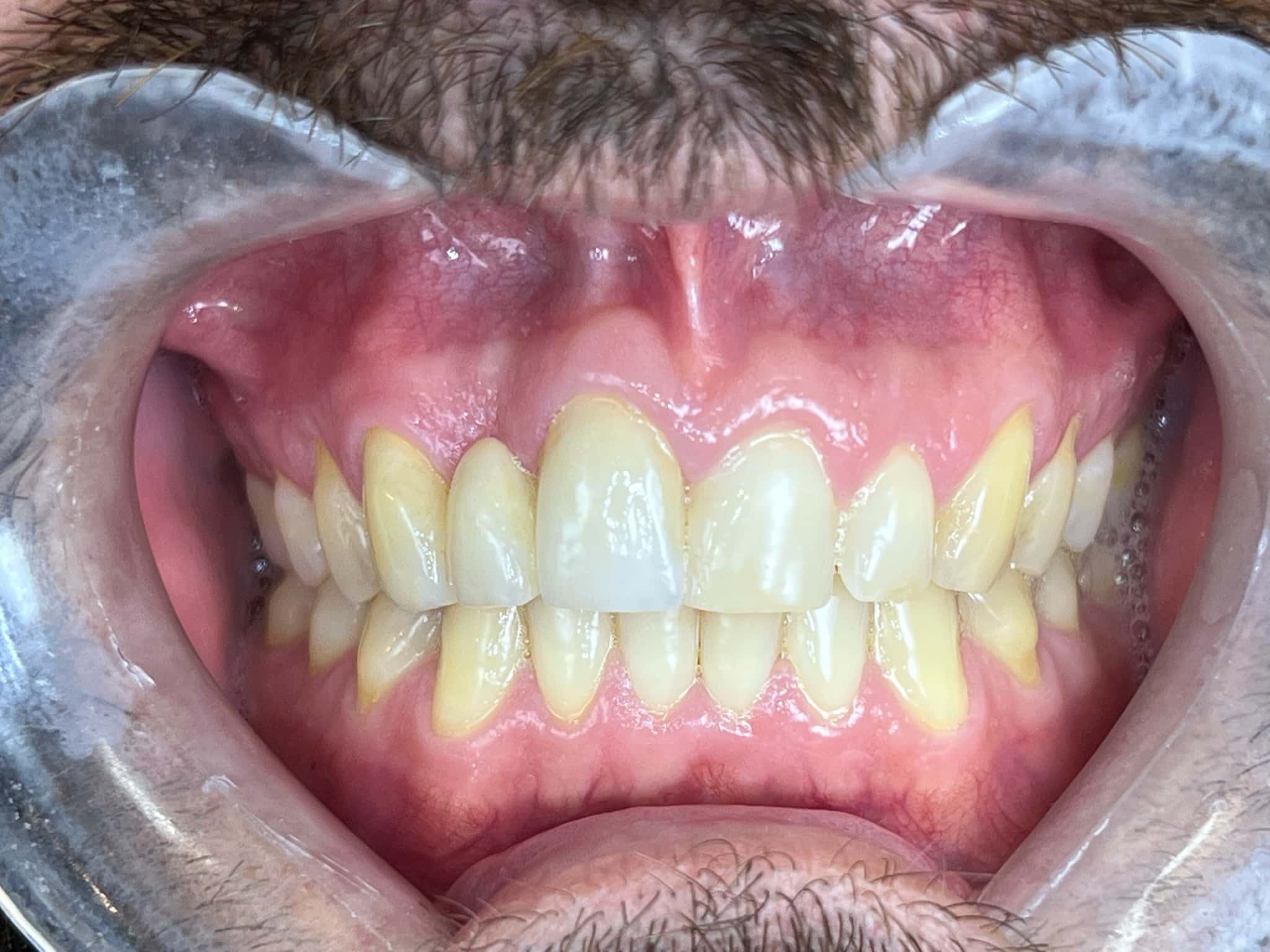 A 3 Unit Dental Bridge • The Good Dentist