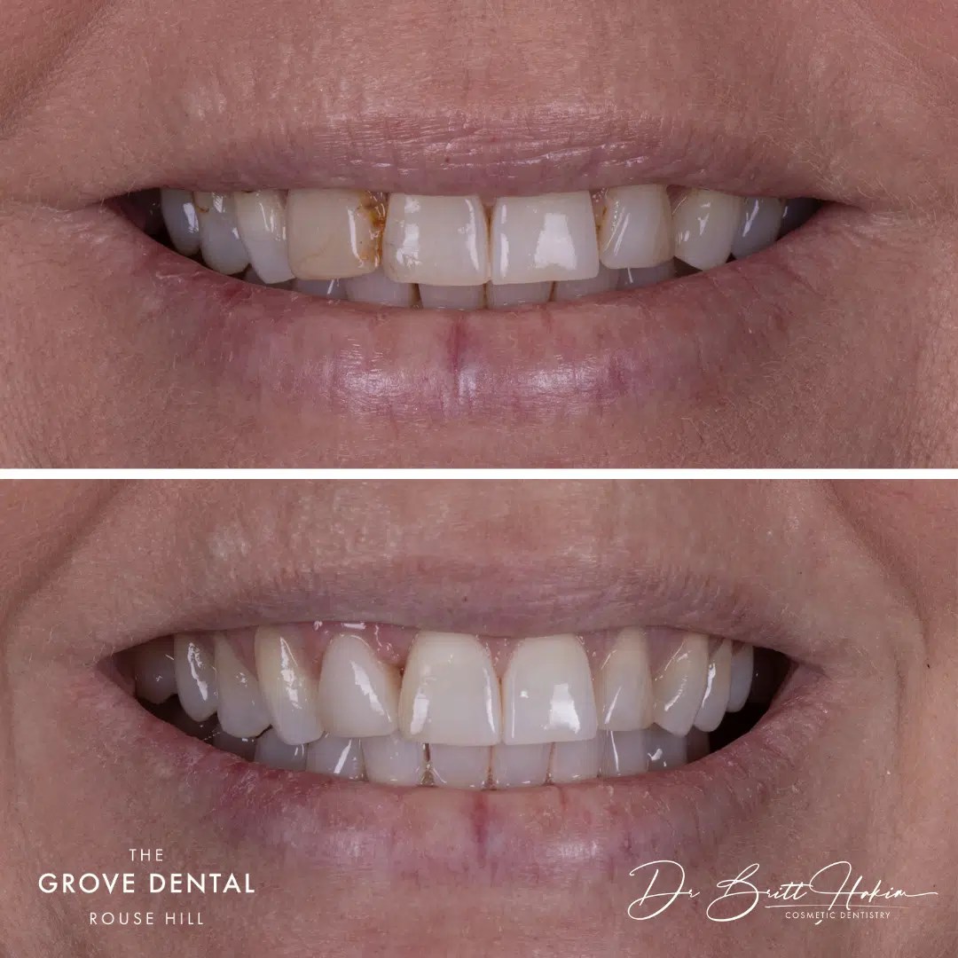 Smile Gallery The Grove Dental Rouse Hill